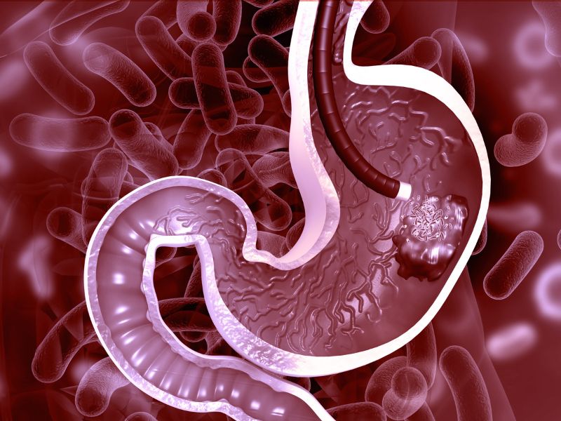 tüp mide ameliyatı