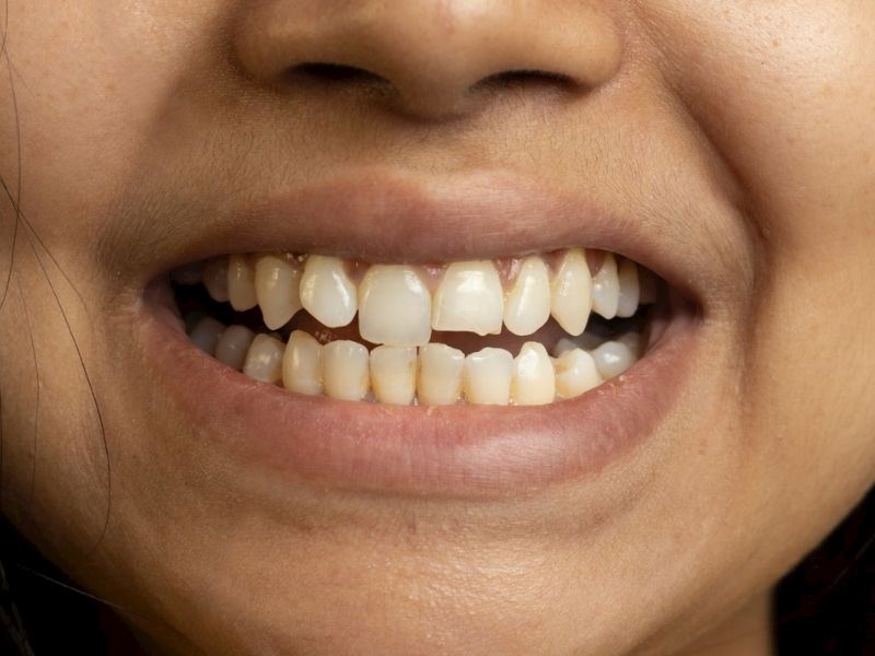 Dişler Neden Yamuk Çıkar? 7 Önemli Etken