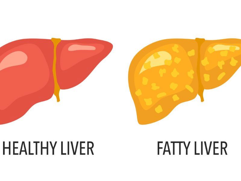 Karaciğer Yağlanması İnsanı Nasıl Etkiler?